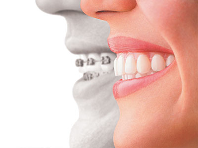 A split-screen image showing a person s face with a smile and the same face with braces, emphasizing dental care.