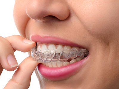 Woman examining her teeth with a clear retainer in hand.